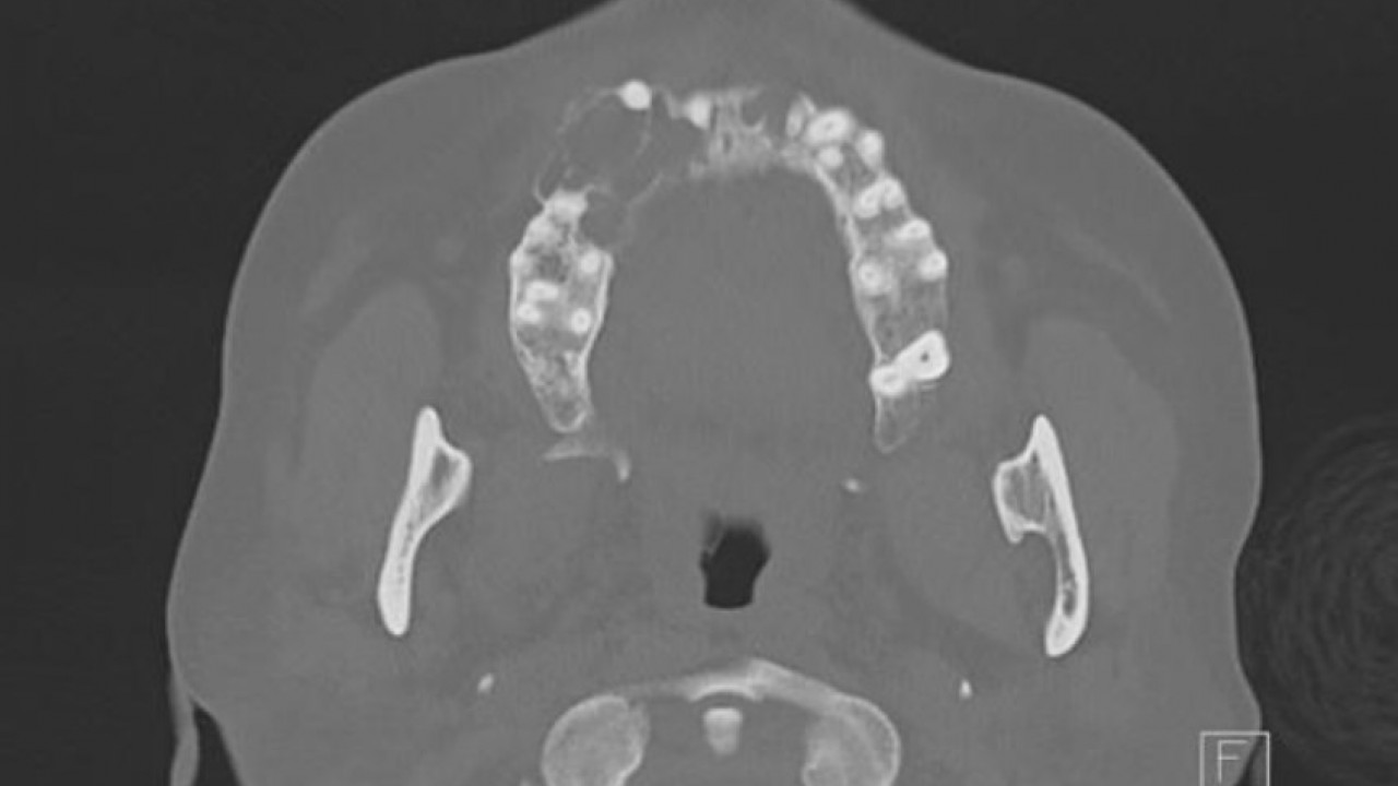 Pediatric Odontogenic Myxoma: A Case Report and a Systematic Review of the Literature